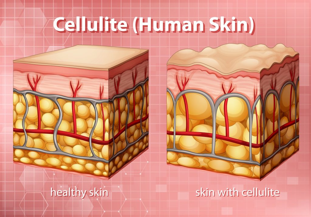 Cellulite Human Skin 