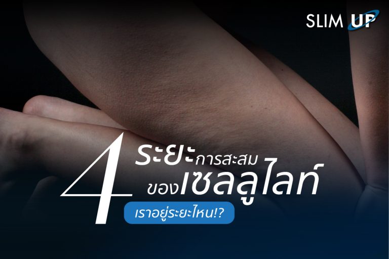 4 ระยะ การสะสม ” เซลลูไลท์ ” เราอยู่ระยะไหน !?