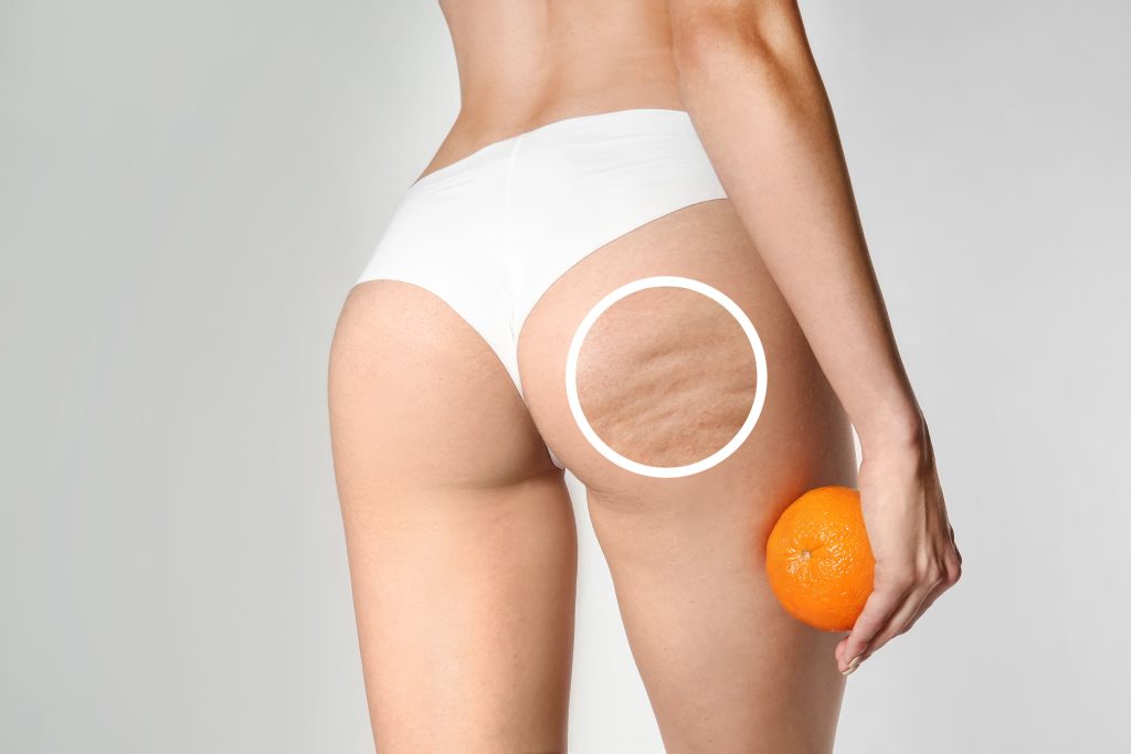 Cellulite 4 stages