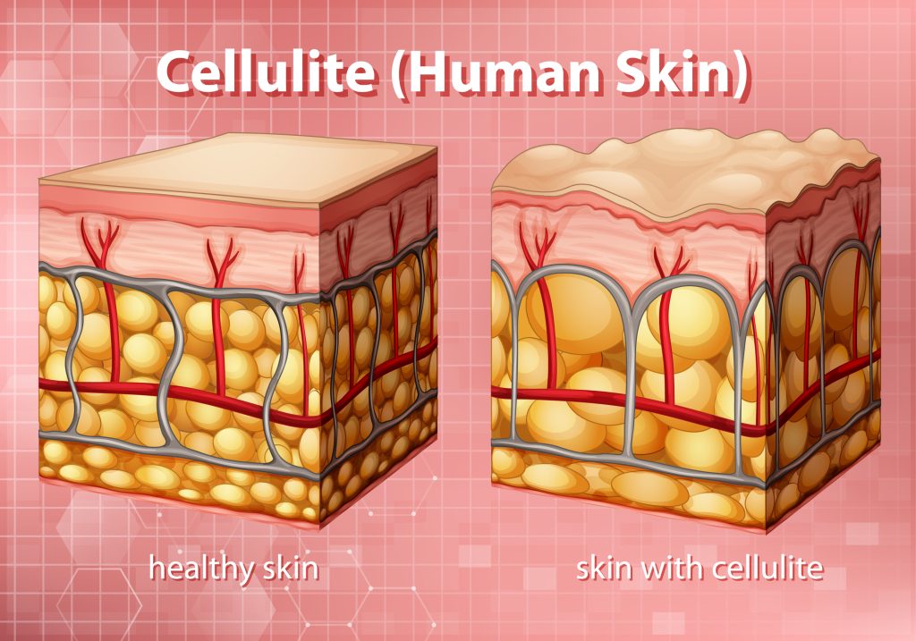 cellulite in human skin
